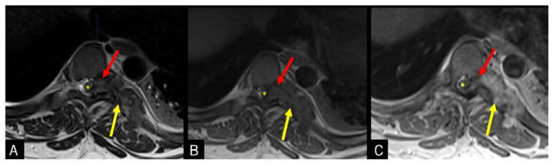 Tophaceous Gout in the Axial Skeleton: An Unusual Case with Key Imaging Characteristics.