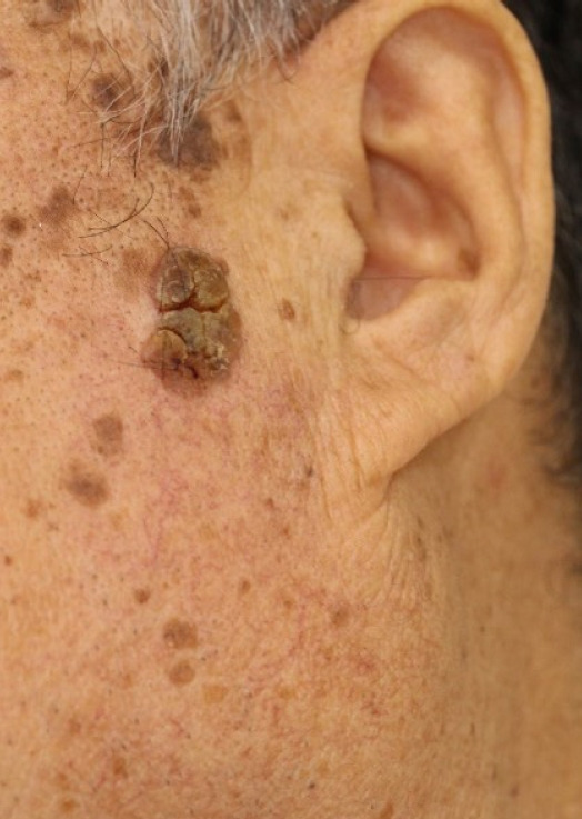 Coexistence of neuroendocrine carcinoma and squamous cell carcinoma of the skin after kidney transplantation: a case report.