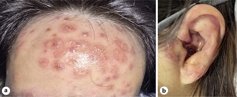 Bullous Vasculitis in Eosinophilic Granulomatosis with Polyangiitis: A Case Report.