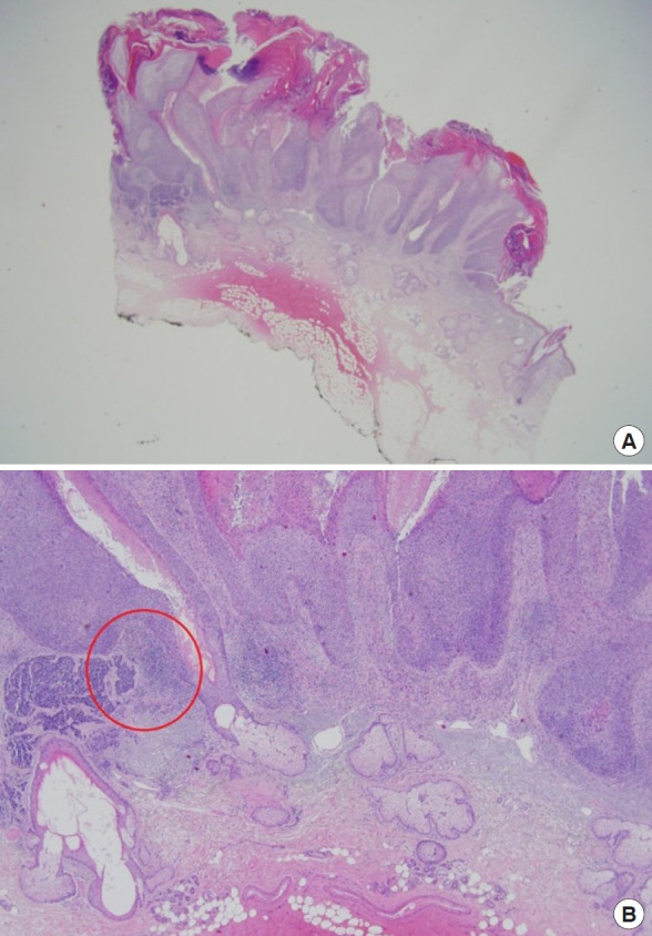 Coexistence of neuroendocrine carcinoma and squamous cell carcinoma of the skin after kidney transplantation: a case report.