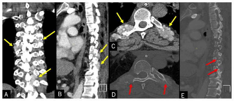 Tophaceous Gout in the Axial Skeleton: An Unusual Case with Key Imaging Characteristics.