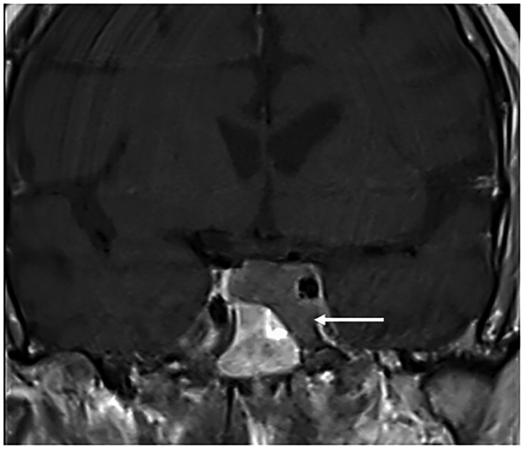 Avascular Necrosis in Patients With Cushing Syndrome.