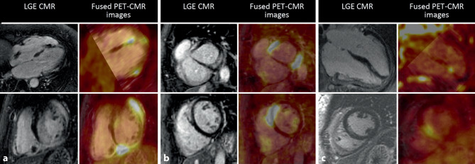 Screening for cardiac sarcoidosis: diagnostic approach and long-term follow-up in a tertiary centre.