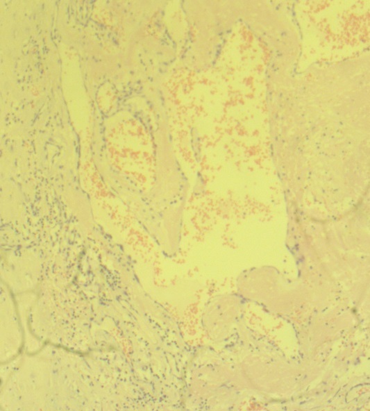 Spontaneous aneurysm of a common digital artery: a rare entity.