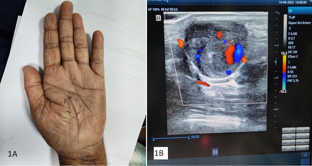 Spontaneous aneurysm of a common digital artery: a rare entity.