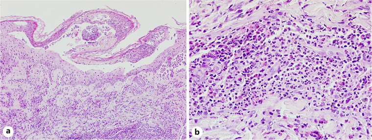 Bullous Vasculitis in Eosinophilic Granulomatosis with Polyangiitis: A Case Report.