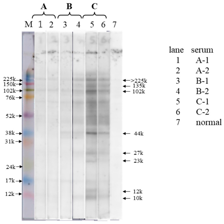 IgE-Crosslinking-Induced Luciferase Expression Test as a Sensitive Indicator of <i>Anisakis</i> Allergy.