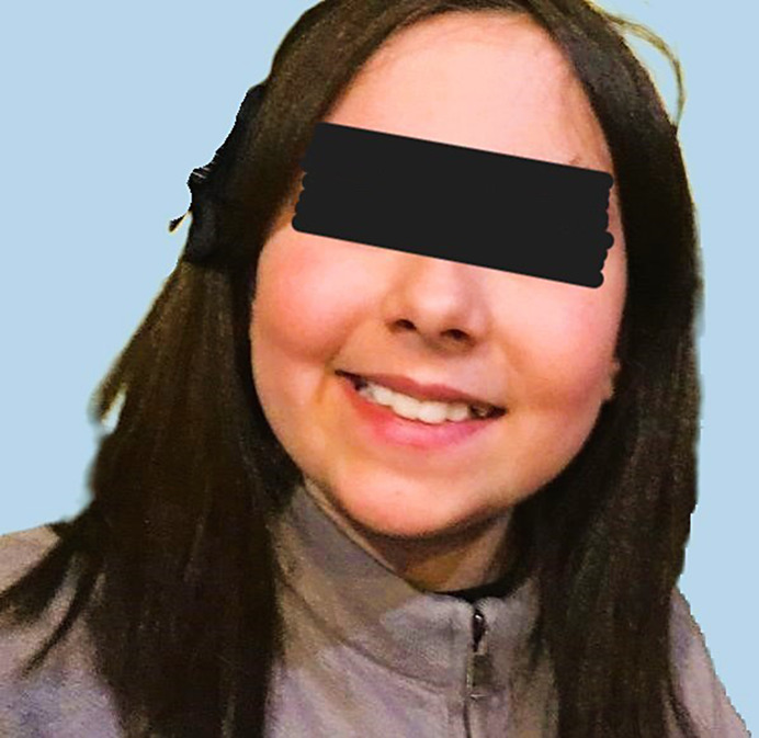 Iatrogenic Cushing Syndrome and Secondary Adrenal Insufficiency in a Child due to Topical Ocular Corticosteroids: A Case Report.