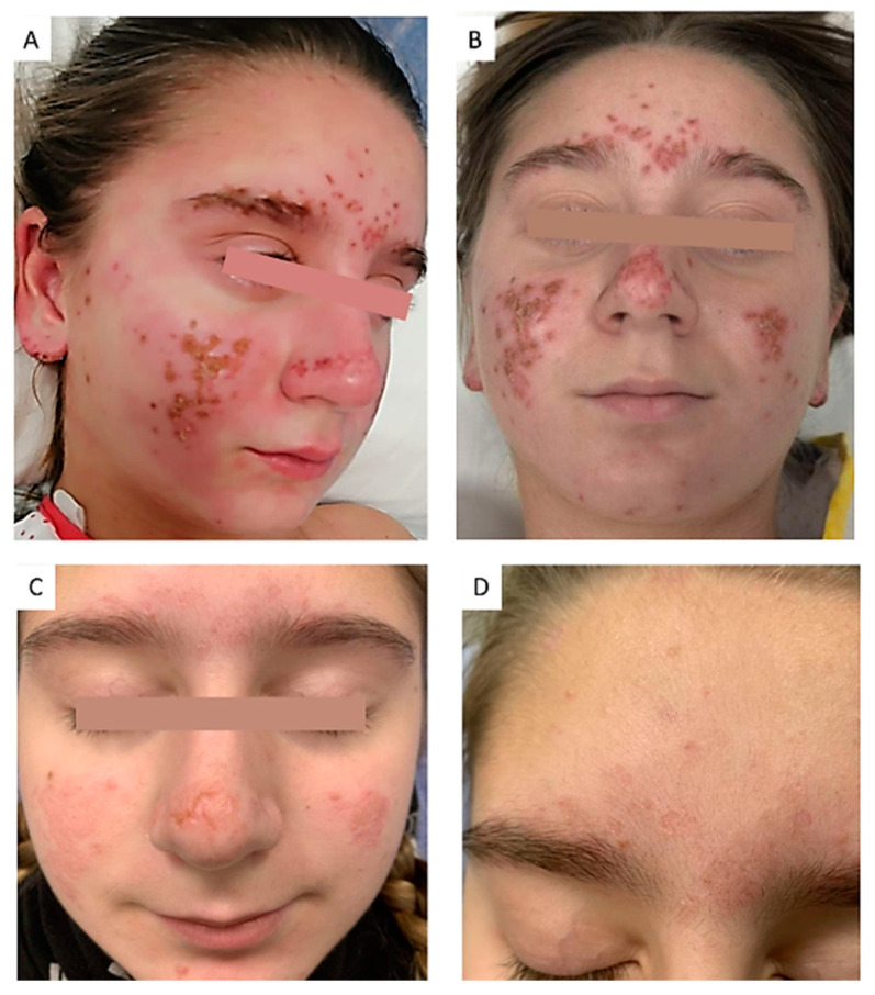 Pediatric Kikuchi-Fujimoto Disease: Case Report and Review of Cutaneous and Histopathologic Features in Childhood.