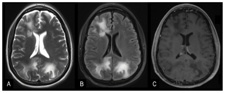 Tophaceous Gout in the Axial Skeleton: An Unusual Case with Key Imaging Characteristics.
