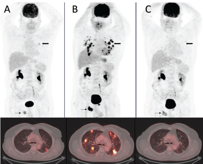 Pseudoprogression Shown on <sup>18</sup>F-FDG PET/CT After Pembrolizumab Treatment in a Case of Metastatic Bladder Cancer.