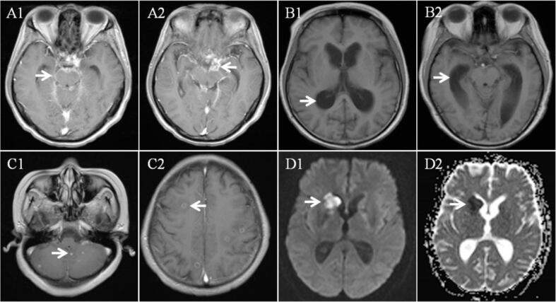 Tuberculous meningitis-related ischemic stroke: A retrospective study from a tertiary care hospital