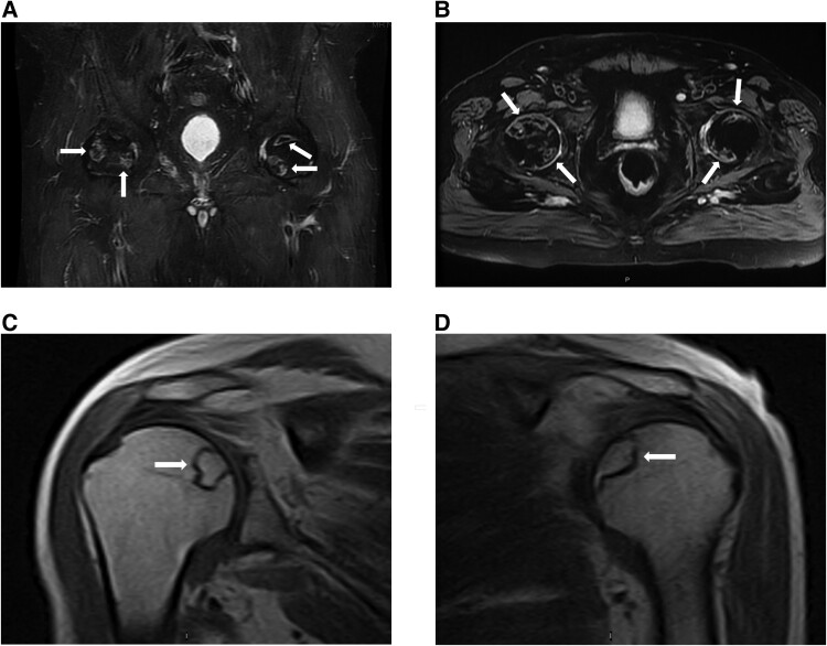 Avascular Necrosis in Patients With Cushing Syndrome.