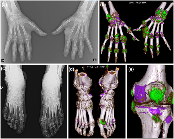 Advanced imaging techniques in crystal arthritis.
