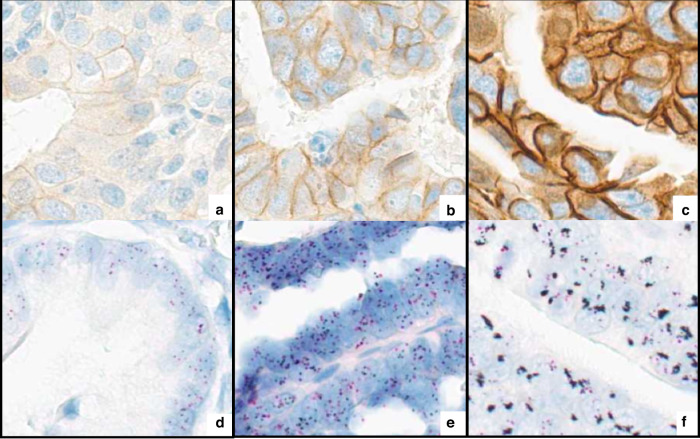HER2 amplification and HER2 low expression in endometrial carcinoma: prevalence across molecular, histological and clinicopathological risk groups.