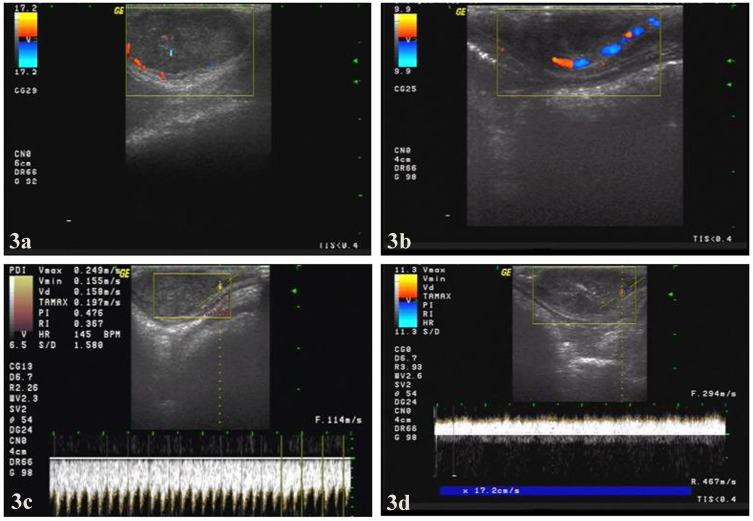 Ultrasound-Guided Percutaneous Microwave Coagulation Studies on VX2 Rabbit Models for Breast Cancer Treatment and Ultrasound Imaging Assessment.