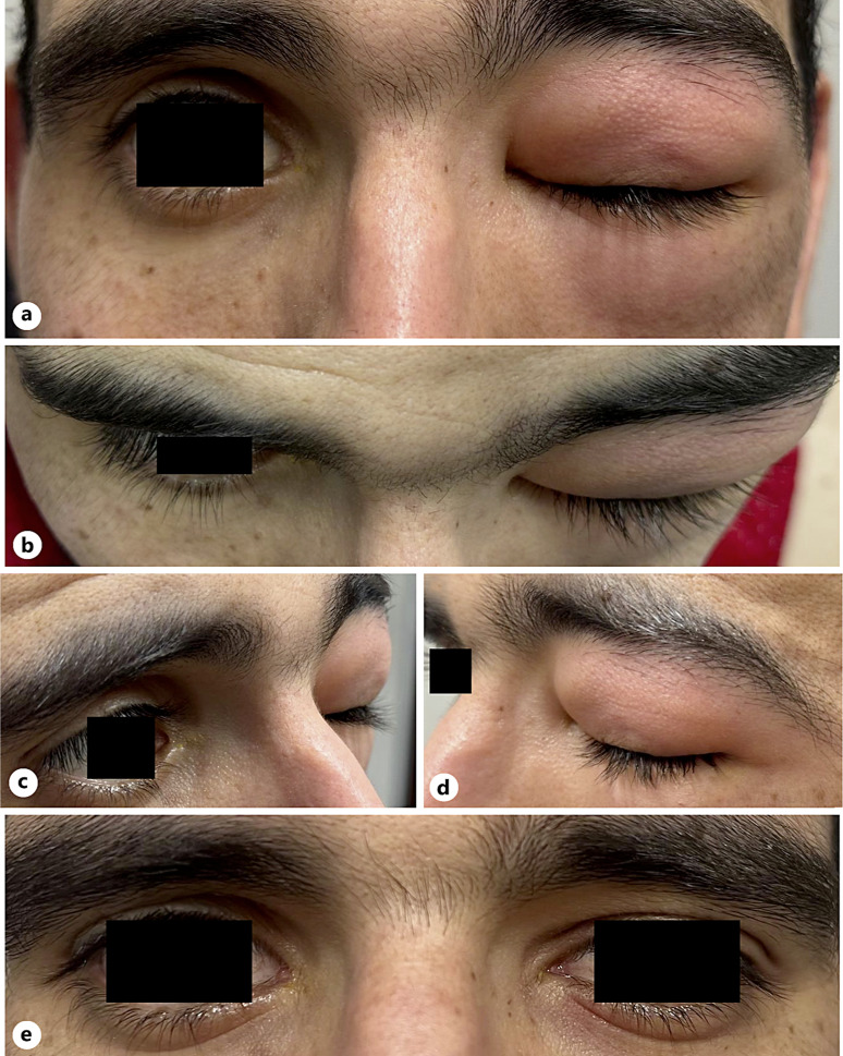 Valsalva-Induced Orbital and Subcutaneous Periorbital Emphysema Secondary to Lamina Papyracea Dehiscence: A Case Report.