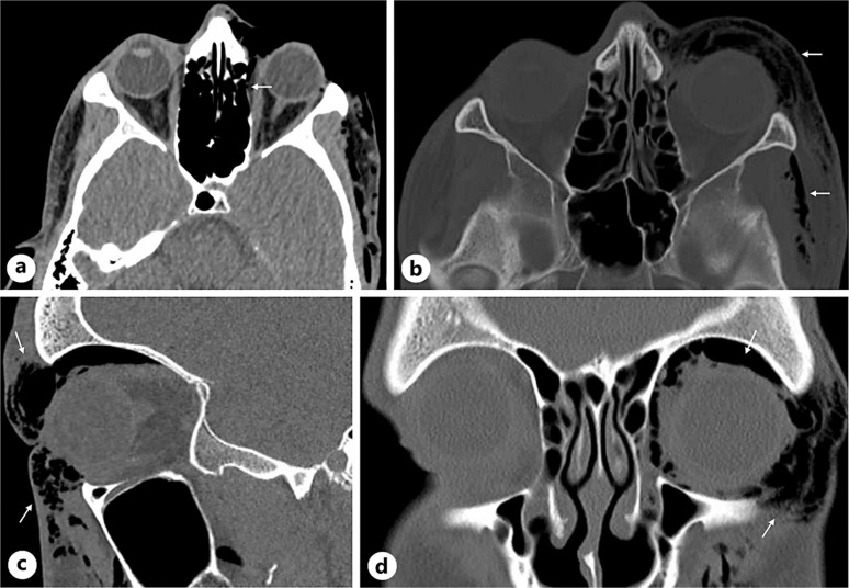 Valsalva-Induced Orbital and Subcutaneous Periorbital Emphysema Secondary to Lamina Papyracea Dehiscence: A Case Report.