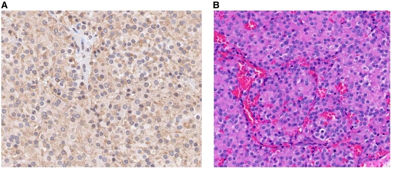 Avascular Necrosis in Patients With Cushing Syndrome.
