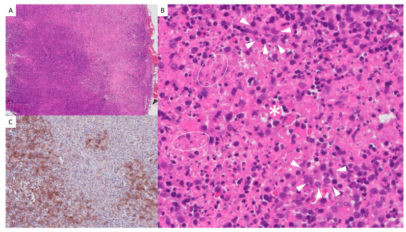 Pediatric Kikuchi-Fujimoto Disease: Case Report and Review of Cutaneous and Histopathologic Features in Childhood.