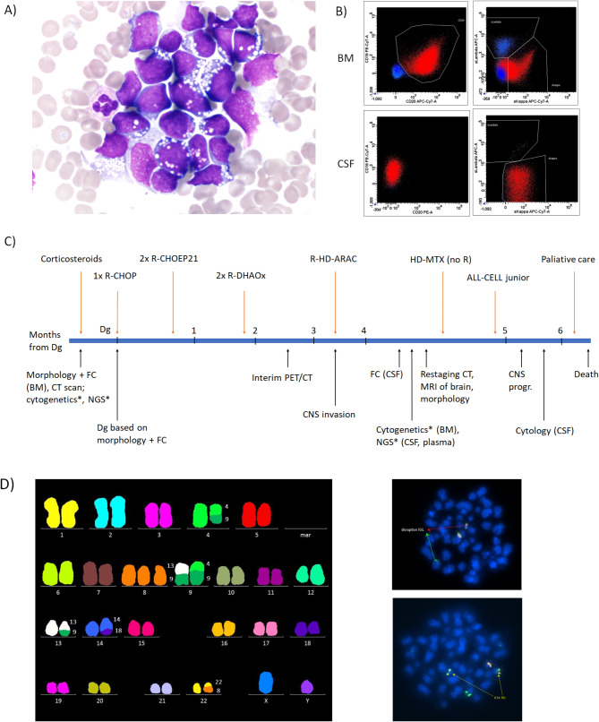 Advanced NGS analysis of cell-free tumor DNA supports clonal relation to primary high-grade B-cell lymphoma lesion and CNS relapse despite MRI negativity.