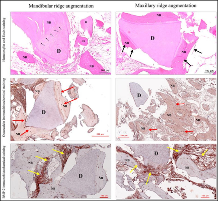 Reducing Healing Period with DDM/rhBMP-2 Grafting for Early Loading in Dental Implant Surgery.