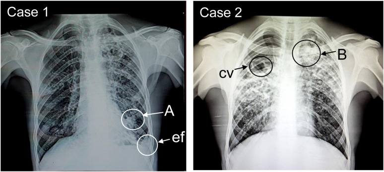 Rapidly progressive silicosis previously diagnosed as pulmonary TB in mineworkers.