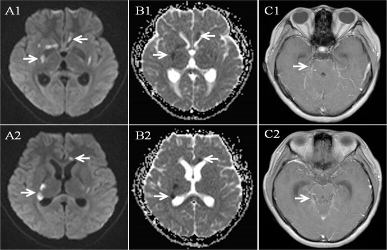 Tuberculous meningitis-related ischemic stroke: A retrospective study from a tertiary care hospital