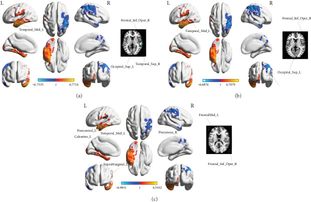 Frequency-Dependent Changes in Wavelet-ALFF in Patients With Acute Basal Ganglia Ischemic Stroke: A Resting-State fMRI Study.