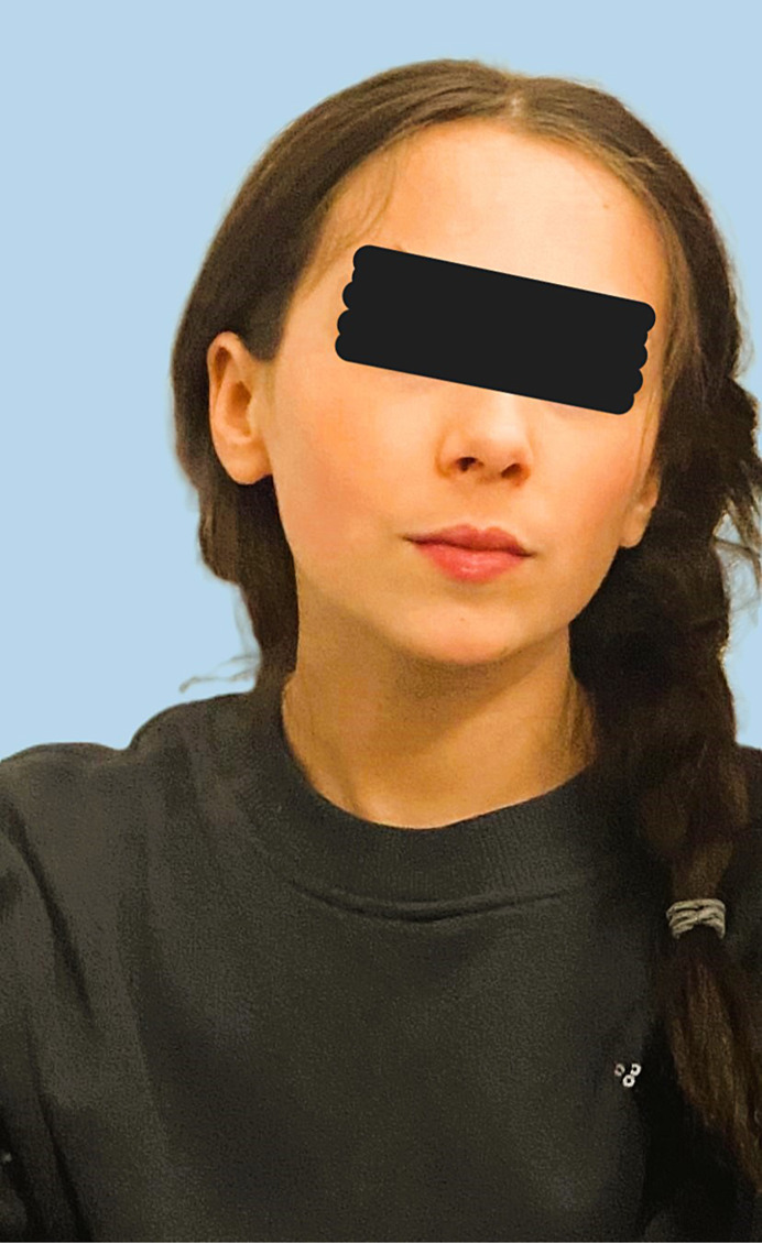 Iatrogenic Cushing Syndrome and Secondary Adrenal Insufficiency in a Child due to Topical Ocular Corticosteroids: A Case Report.