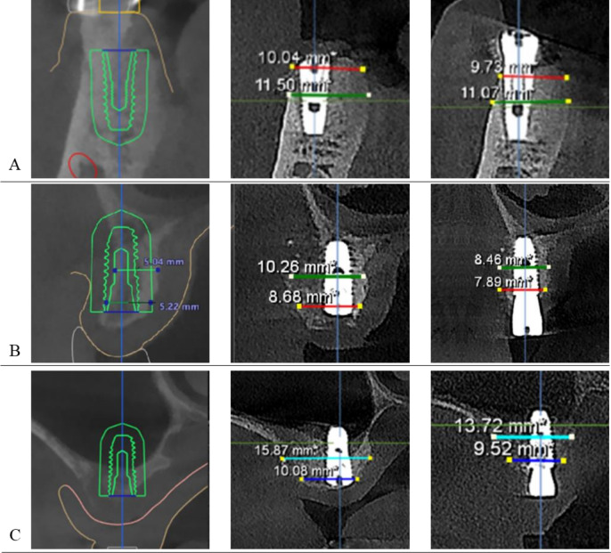 Reducing Healing Period with DDM/rhBMP-2 Grafting for Early Loading in Dental Implant Surgery.