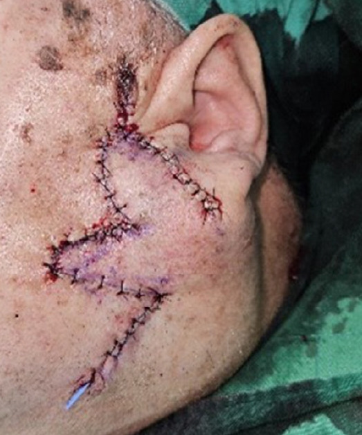 Coexistence of neuroendocrine carcinoma and squamous cell carcinoma of the skin after kidney transplantation: a case report.