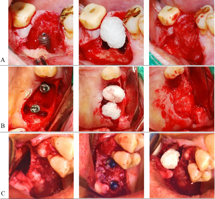 Reducing Healing Period with DDM/rhBMP-2 Grafting for Early Loading in Dental Implant Surgery.