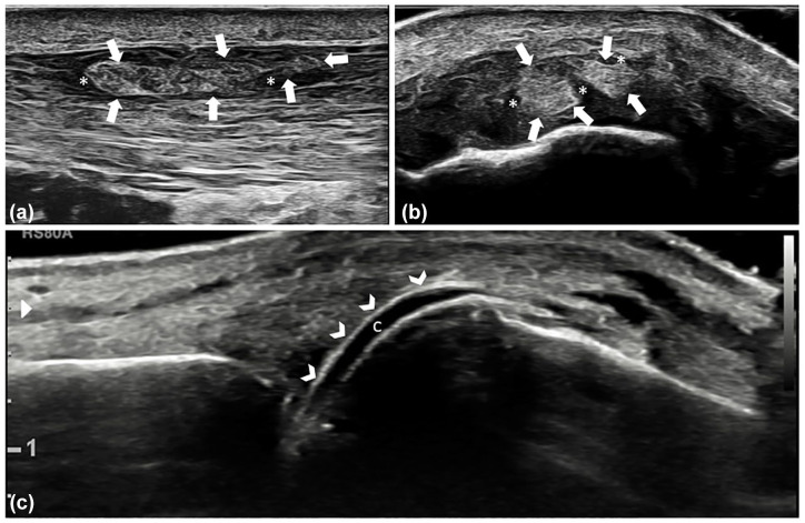Advanced imaging techniques in crystal arthritis.
