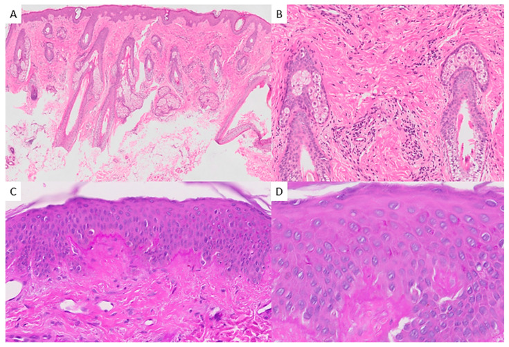Pediatric Kikuchi-Fujimoto Disease: Case Report and Review of Cutaneous and Histopathologic Features in Childhood.