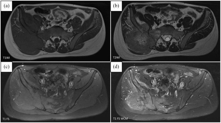 Ewing Sarcoma Presenting as Fever of Unknown Origin (FUO) in Children: A Case Report and Brief Review of the Literature.