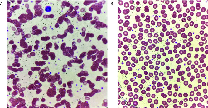 Red blood cell agglutination caused by ceftriaxone and its effect on erythrocyte parameters: a case report.