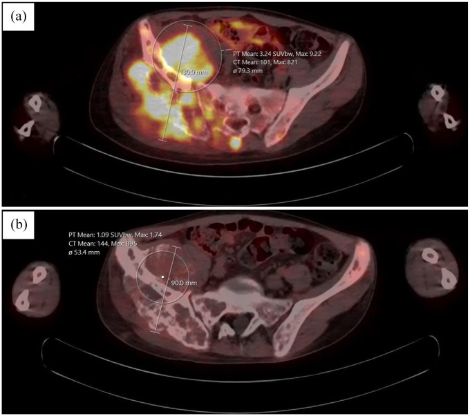 Ewing Sarcoma Presenting as Fever of Unknown Origin (FUO) in Children: A Case Report and Brief Review of the Literature.