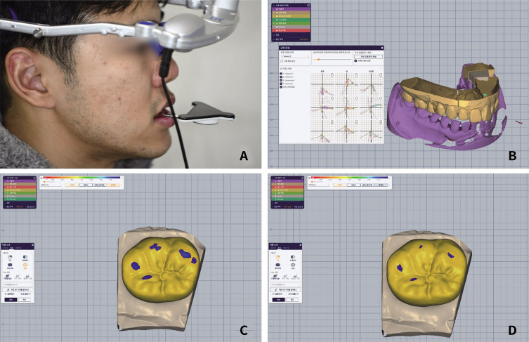 Comparison of interference from eccentric movements of dental crowns fabricated via dynamic jaw motion tracking and conventional methods: a double-blind clinical study.