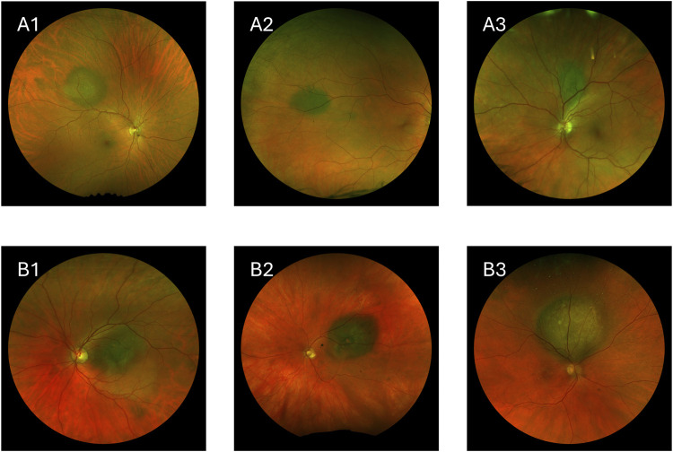 Artificial intelligence in the diagnosis of uveal melanoma: advances and applications.