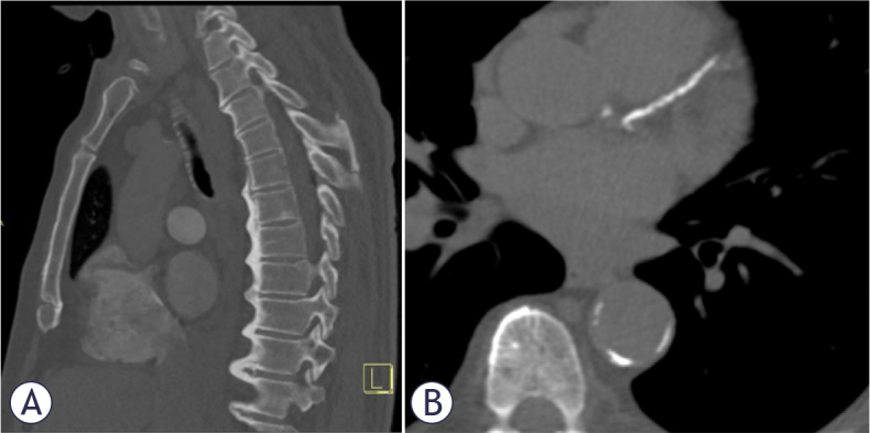 Prevalence of diffuse idiopathic skeletal hyperostosis and association with coronary artery calcifications in Slovenia.