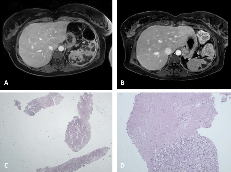 Aseptic Abscess Syndrome: A Unique Case of Splenic Involvement and Systemic Inflammation.