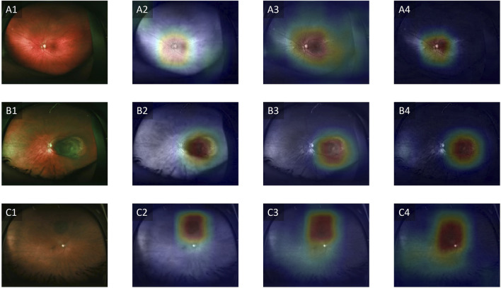 Artificial intelligence in the diagnosis of uveal melanoma: advances and applications.