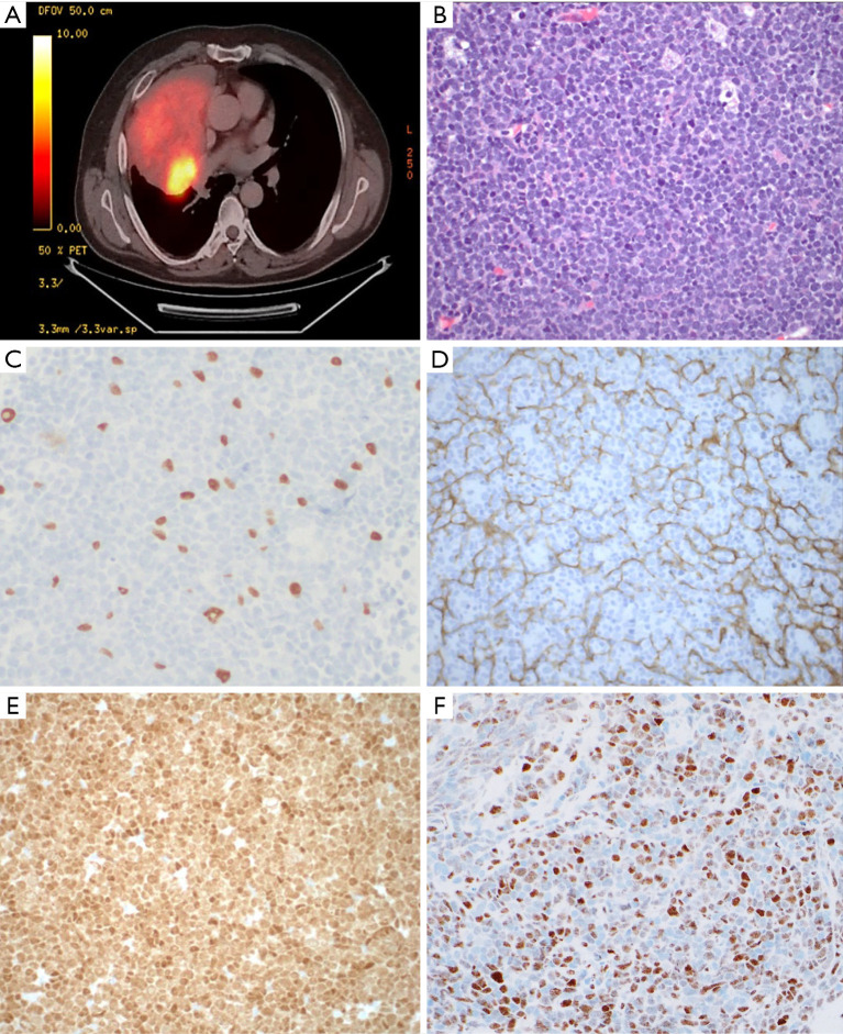 Co-occurrence of thymoma and acute T-lymphoblastic leukemia/lymphoma: a case report and literature review.