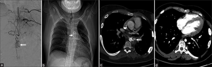 Anesthetic management of endovascular embolization in a patient of neurofibromatosis with associated aortic and multisystemic vasculopathy: A case report.