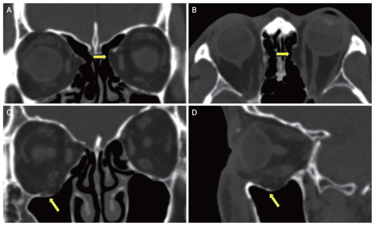 Ocular Injuries in Patients with Old Blowout Fractures Following Blunt Trauma.