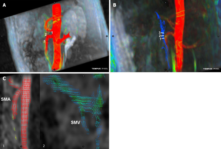 Assessment of superior mesenteric vascular flow quantitation in children using four-dimensional flow magnetic resonance imaging: A feasibility study.