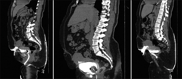 Vesicouterine Cutaneous Fistula Post-cesarean Section - A Case Report.