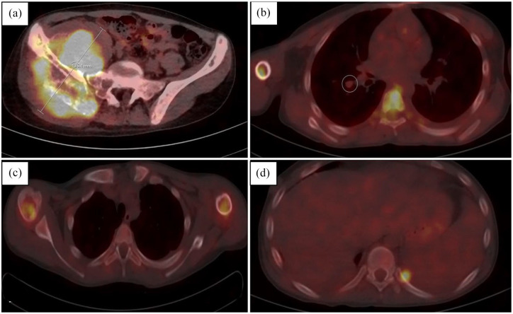 Ewing Sarcoma Presenting as Fever of Unknown Origin (FUO) in Children: A Case Report and Brief Review of the Literature.