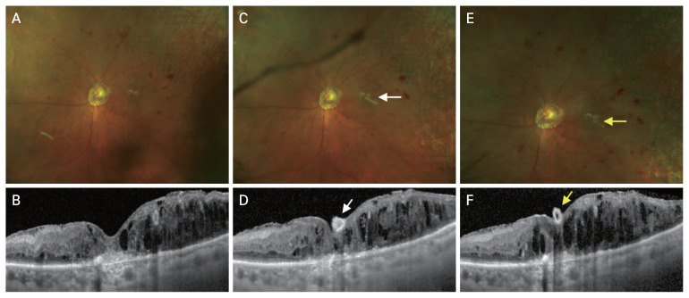 A Dexamethasone Implant Adherent to Fovea: A Case Report.